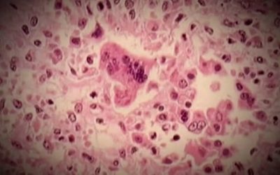 Public Health confirms case of measles in the Moncton area | CBC News