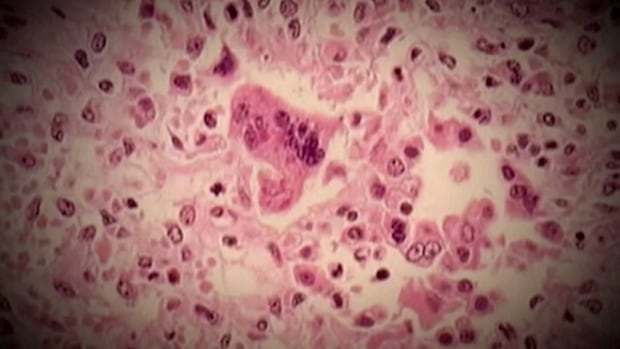 public-health-confirms-case-of-measles-in-the-moncton-area-|-cbc-news