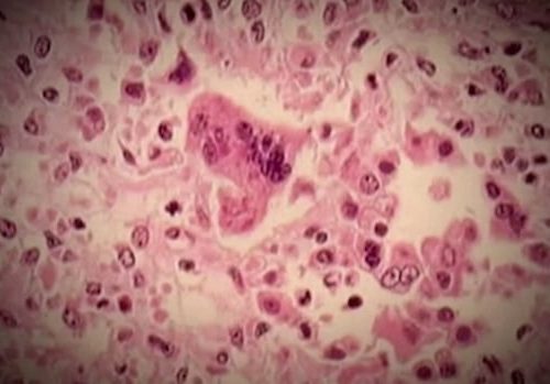 no-new-measles-cases-in-nb.-after-1-identified-in-moncton-|-cbc-news